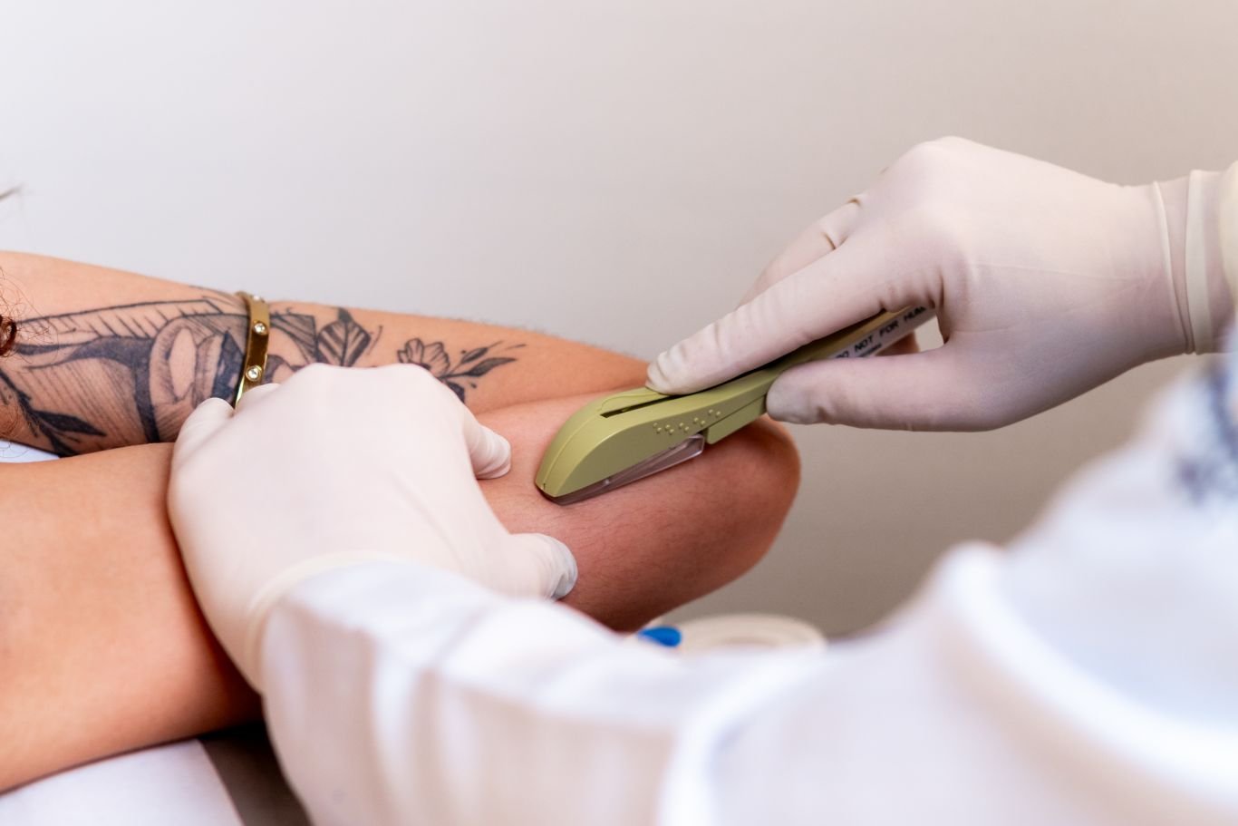 Aplicador do Implanon no blister estéril, o implante do tamanho de um fósforo